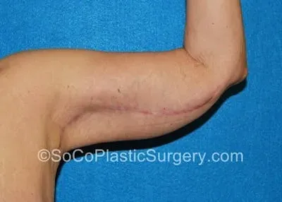 Brachioplasty #3 after