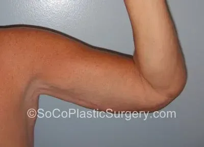Brachioplasty #2 after