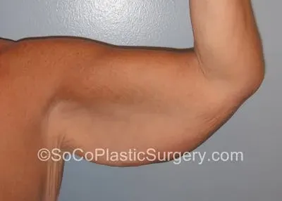 Brachioplasty #2 before