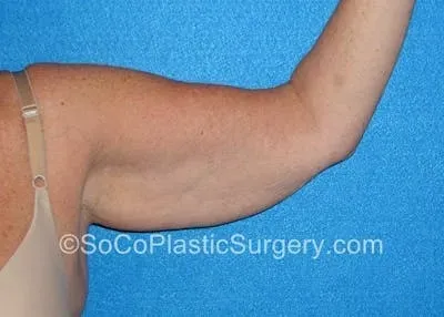 Brachioplasty #4 before
