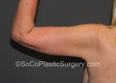Brachioplasty #1 after