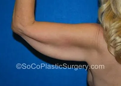 Brachioplasty #1 before