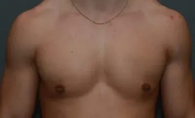 Gynecomastia #5 after