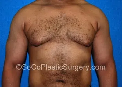 Gynecomastia #11 before