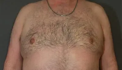 Gynecomastia #3 after