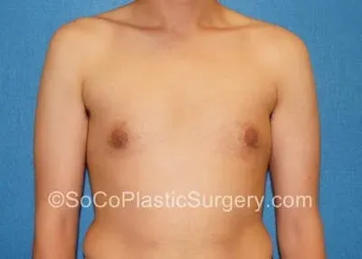 Gynecomastia #10 after