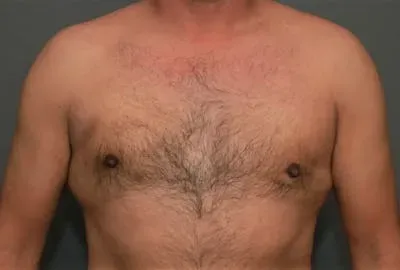 Gynecomastia #1 after