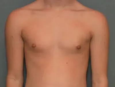Gynecomastia #6 after