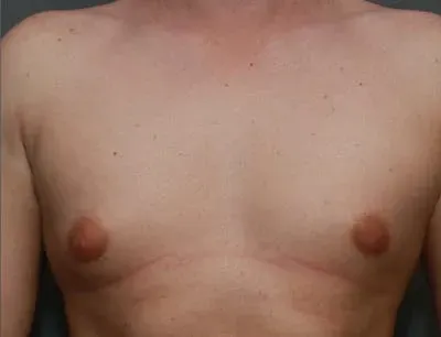 Gynecomastia #7 before