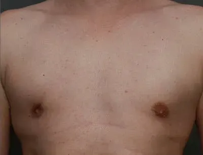 Gynecomastia #7 after