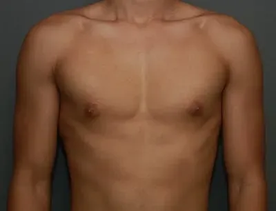 Gynecomastia #9 before