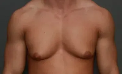 Gynecomastia #5 before