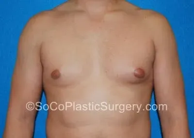Gynecomastia #12 before
