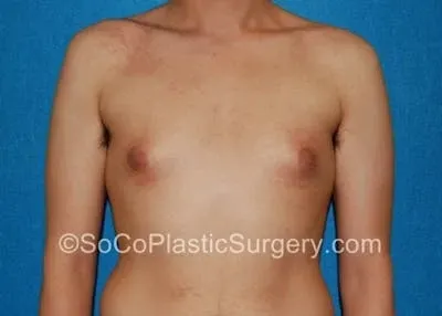 Gynecomastia #10 before
