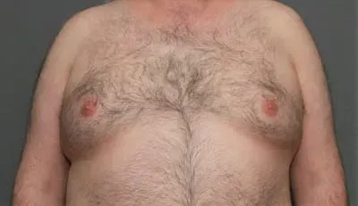 Gynecomastia #3 before