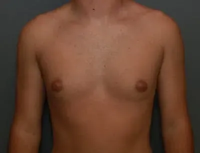 Gynecomastia #8 before