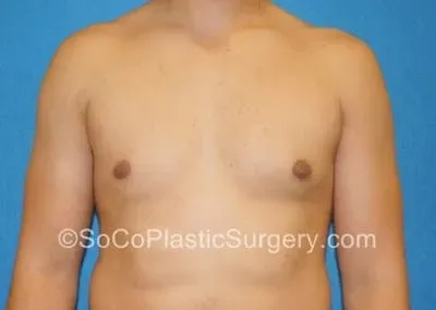 Gynecomastia #12 after
