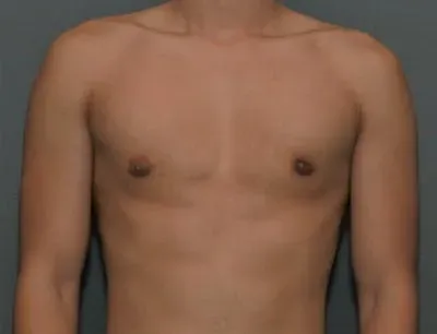 Gynecomastia #9 after