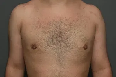 Gynecomastia #2 after