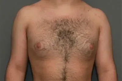 Gynecomastia #2 before