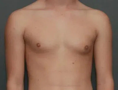 Gynecomastia #6 before