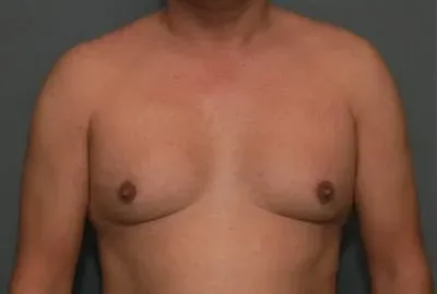 Gynecomastia #1 before