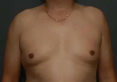 Gynecomastia #4 before