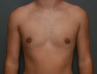 Gynecomastia #8 after