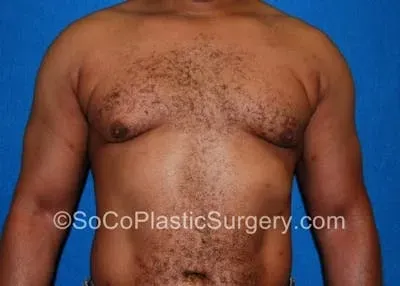Gynecomastia #11 after