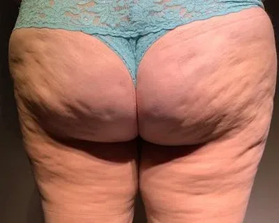 Microcannula Liposuction #2 before