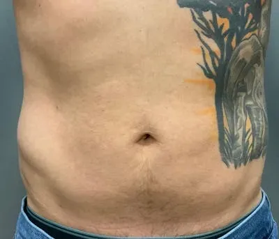 Microcannula Liposuction #4 after