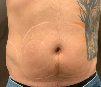 Microcannula Liposuction #4 before