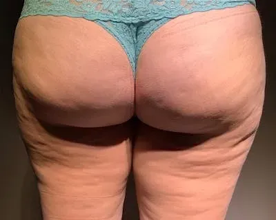 Microcannula Liposuction #2 after