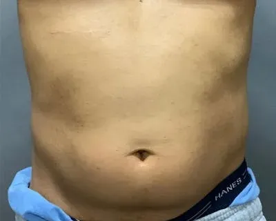 Microcannula Liposuction #1 before