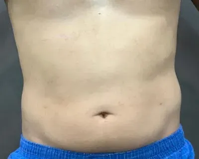 Microcannula Liposuction #1 after