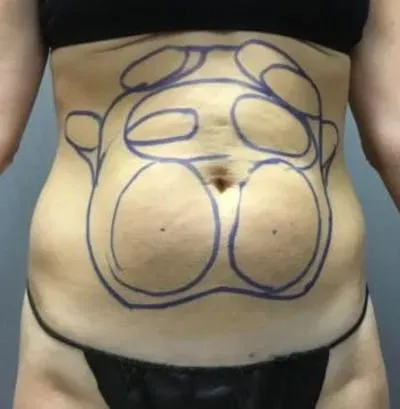 Microcannula Liposuction #5 before