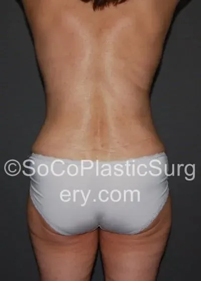 Tummy Tuck #11 after