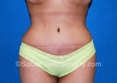Tummy Tuck #9 after