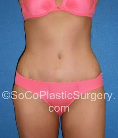 Tummy Tuck #1 after