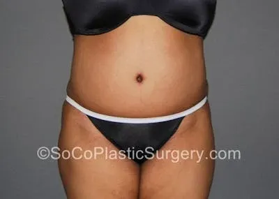 Tummy Tuck #12 after