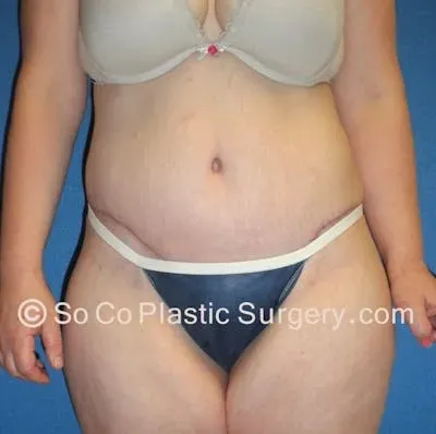 Tummy Tuck #14 after