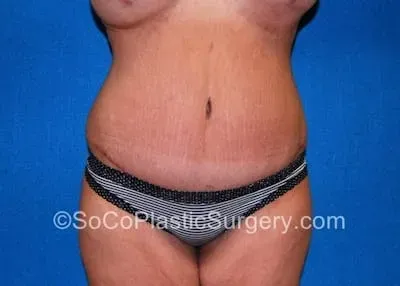Tummy Tuck #15 after