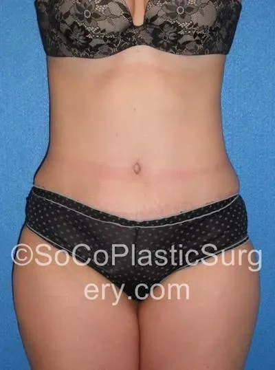 Tummy Tuck #7 after