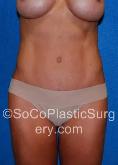 Tummy Tuck #13 after