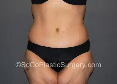 Tummy Tuck #6 after