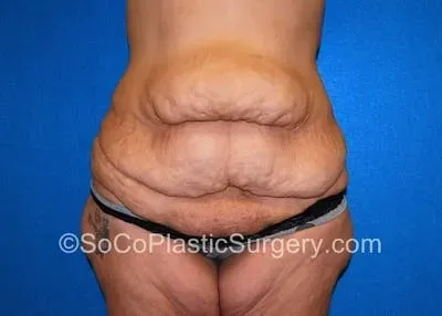 Tummy Tuck #6 before