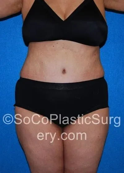Tummy Tuck #20 after