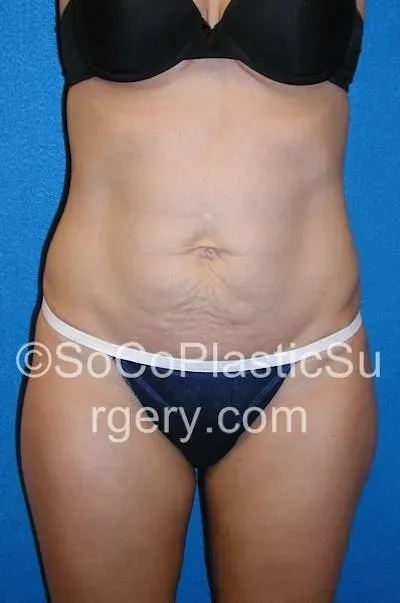 Tummy Tuck #2 before