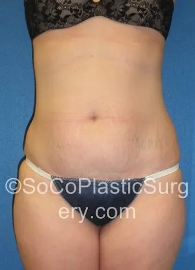 Tummy Tuck #7 before