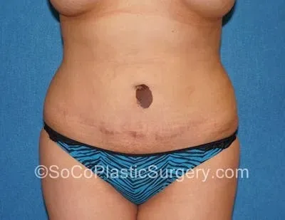 Tummy Tuck #9 before
